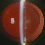 Toric IOL perfectly aligned in